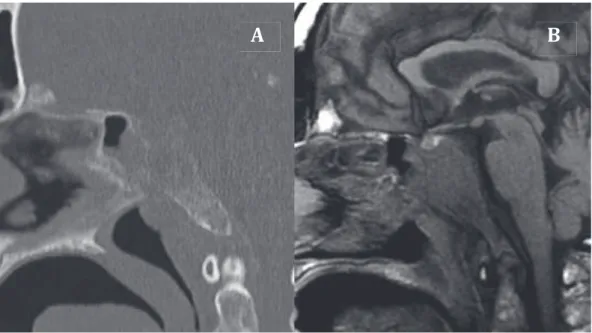 Figure 10 : métastase du sphénoïde en coupe sagittale TDM (A) et IRM T1 (B)