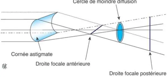 Figure 5 : La conoïde de Sturm [15] 