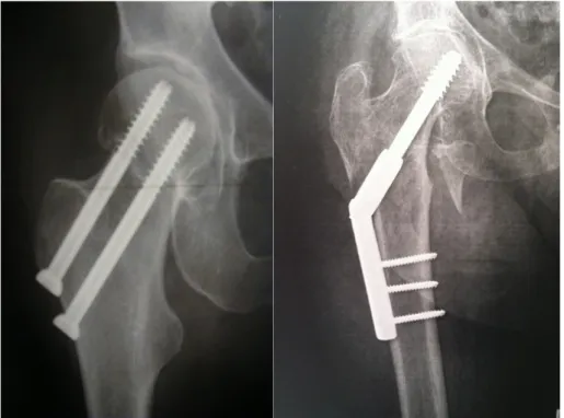 Figure 3 : différents types d’ostéosynthèse de fractures cervicales 