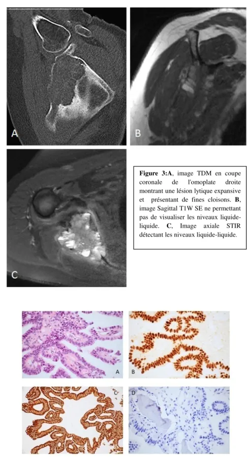 Figure  3:A,  image  TDM  en  coupe  coronale  de  l'omoplate  droite  montrant une lésion lytique expansive  et    présentant  de  fines  cloisons