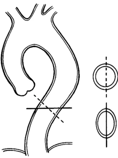 Figure 2 : Illustration de la différence de diamètre entre une reconstruction dans l’axe de l’AT  en double oblique (trait pointillé) et un diamètre axial sans reconstruction (trait plein) 