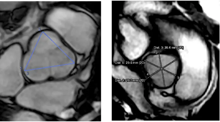 Figure 4 : Illustration des mesures de la racine aortique au niveau des sinus de Valsalva sur  une valve tricuspide sur la séquence 2D ciné b-SSFP : mesures cusp (à gauche) et 