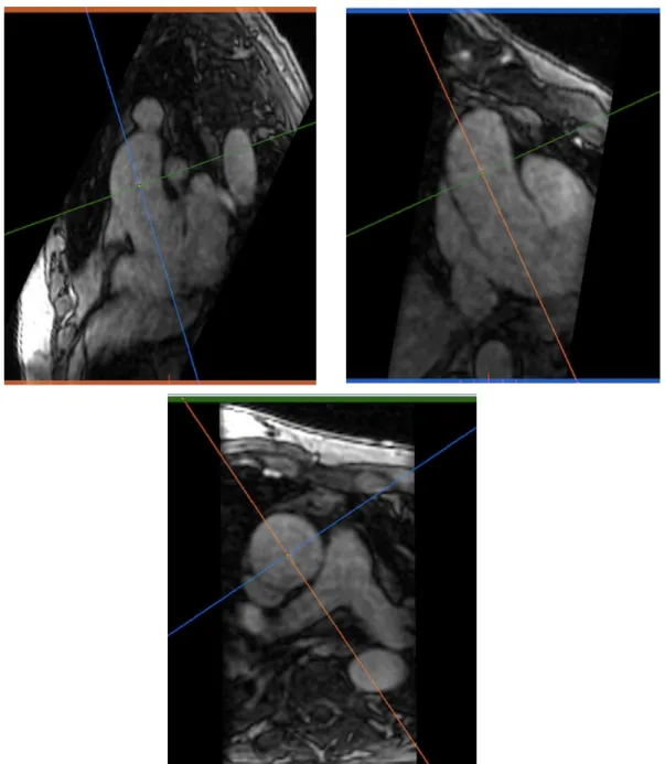 Figure 5 : Mesure en double oblique l’aorte thoracique (manchon ascendant) sur la séquence  morphologique 4D flow  