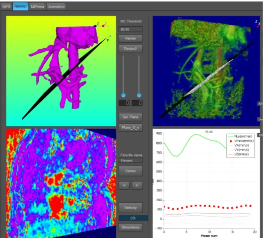 Figure 5 - Post-traitement des images de flux issues de la séquence 3D 