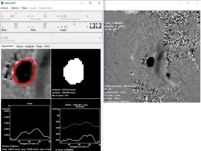 Figure  6 - Post-traitement des images de flux issues de la séquence 2D.  