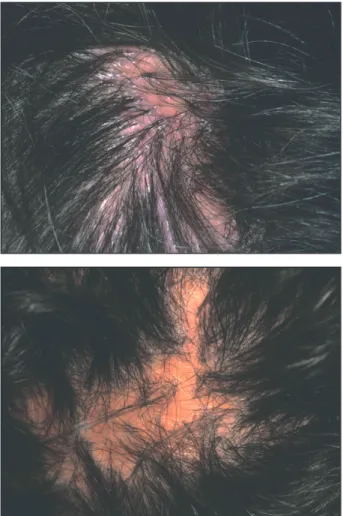 Figure 1. Alopécie cicatricielle : disparition des ostiums folliculaires.