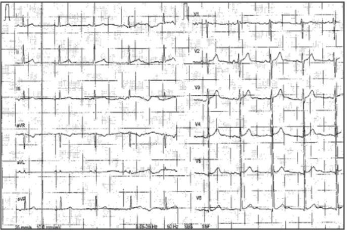 Figure 1. Electrocardiogramme de repos normal.