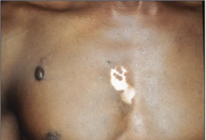 Figure  2.  Aspect  squameux  et  fluorescent  du  pityriasis  versicolor  au  Visioscan ® .