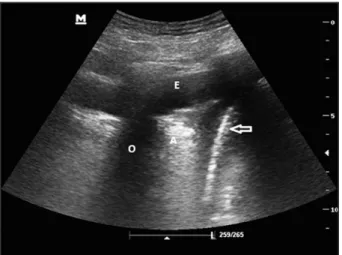 Figure 2. Epanchement pleural basal libre hypoéchogène avec atélectasie  partielle. E: épanchement pleural, A: atélectasie, O: ombre costale, flèche: 