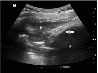 Figure 5. Aspect d’un ‘ring-down artefact’ ou ligne B, la répétition de celles- celles-ci témoigne d’un phénomène infiltratif (œdème pulmonaire, contusion,  bron-chopneumonie, pneumopathie infiltrative diffuse).