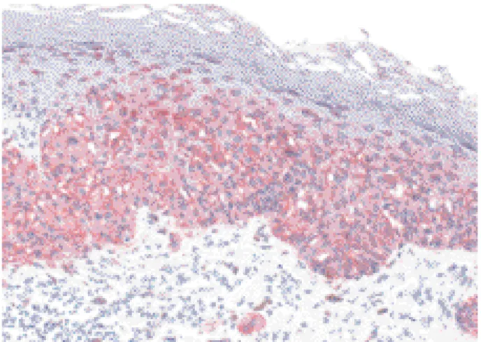 Fig. 5 : Dépôts d’immunoglobulines à la jonction dermo-épider-