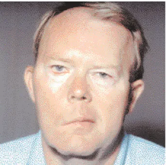Fig. 3. Mauvais résultat – Nette asymétrie faciale postopératoire.