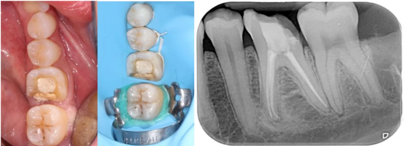 Figure 11 : Photographies de la situation initiale montrant la 36 après traitement endodontique avant  et après la mise en place de la digue, ainsi que la radiographie rétro-alvéolaire pré-opératoire  