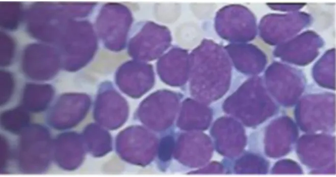 Figure 9: Observation microscopique de blastes dans une leucémie aiguë lymphoblastique  