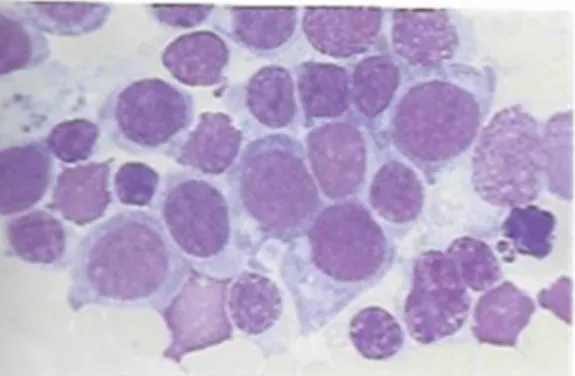 Figure 11: Observation microscopique de blastes dans une leucémie aiguë myéloïde  