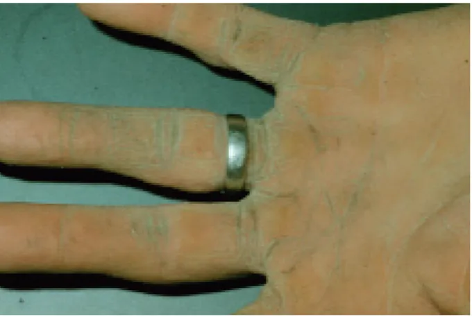Figure 1 : main sèche causée par le contact répétitif avec du cimentE. XhauflairE-uhoda , G.E