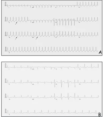 Figure  2. A. Tachycardie  par  réentrée  intranodale.  Les  flèches  indiquent  l’onde P rétrograde à la fin du complexe QRS