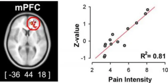 Figure 1 Analyse covariante entre l’intensité douloureuse moyenne (durant l’IRM) et  l’activité  cérébrale  pendant  les  phases  de  douleurs  spontanées  montrant  une  activation d’un cluster unique du cortex préfrontal médial Baliki et al, 2006