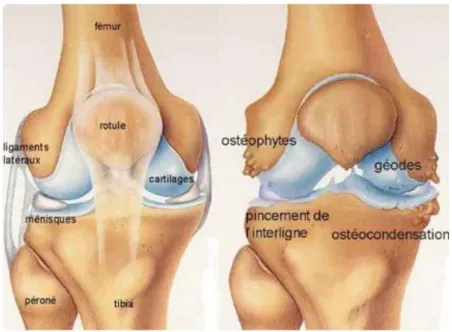Figure 8 :  Schéma d’un genou normal à gauche et genou arthrosique à droite (source :  http://www.docteurrouxel.com/) 