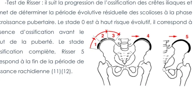 Figure 1 : stades de Risser 