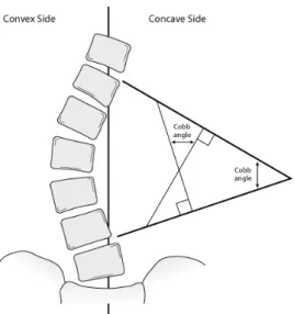 Figure 2 : angle de Cobb 