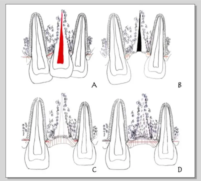 Figure 9 : Illustration schématisée du développement osseux après décoronation d’une dent  ankylosée 