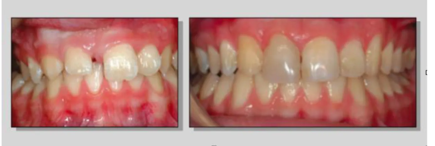 Figure 12 : Exemple de fermeture d’espace orthodontique après extraction. 