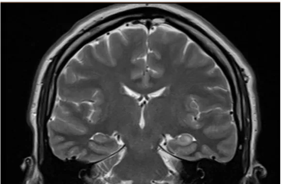 Figure 3 : IRM cérébrale, coupe coronale, séquence pondérée en T2. Hypersignal de l’hippocampe  gauche : sclérose hippocampique.