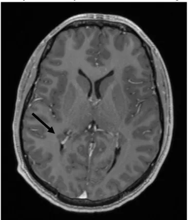 Figure 4 : IRM cérébrale, coupe axiale, séquence T1 avec injection de gadolinium. 