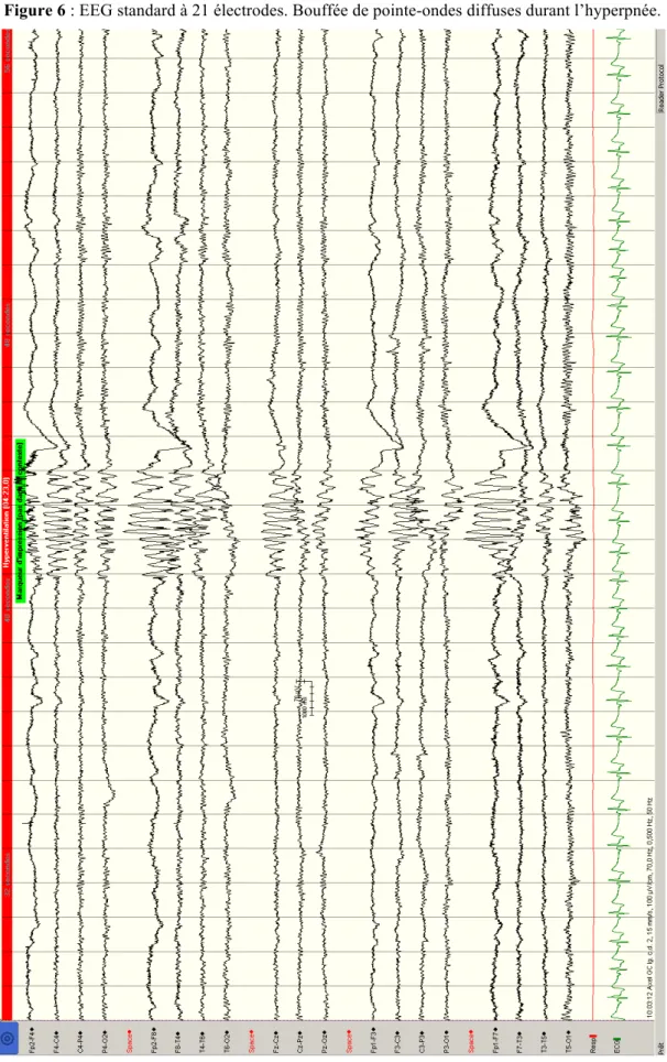 Figure 6 : EEG standard à 21 électrodes. Bouffée de pointe-ondes diffuses durant l’hyperpnée.