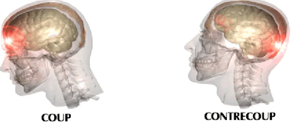 Figure 2 : Effet de &#34;coup-contrecoup&#34; 