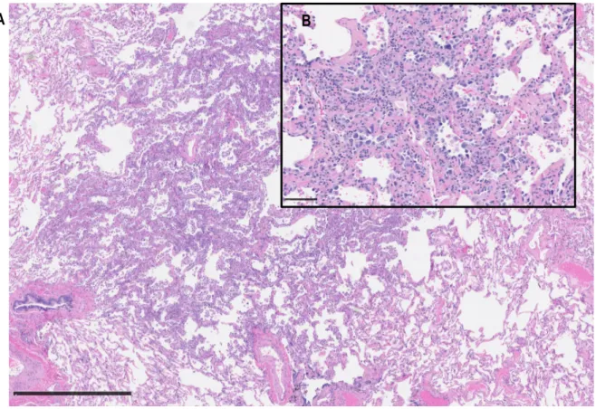 Figure 1.8. Hyperplasie adénomateuse atypique au microscope optique x60 (A) et x325 (B), coloration à  l’hématoxiline-éosine