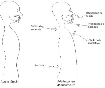 Figure 3: Incidence de l'hypotonie musculaire sur la posture et effet de la posture sur le positionnement des  structures buccales 