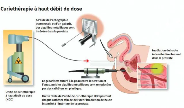 Figure 2 : Curiethérapie de haut débit de dose 
