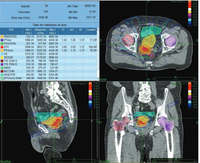 Figure 6 : Plan de traitement par CyberKnife® pour un patient présentant  une récidive tumorale au niveau de la vésicule séminale droite et de la 