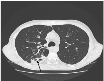 Figure 1 Scanner thoracique montrant une condensation basale droite avec cavitations (flèche).