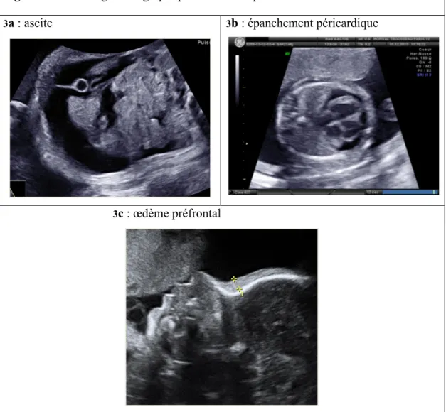 Figure 3 – Sémiologie échographique de l’anasarque fœtale 