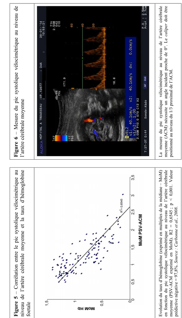 Figure 5 – Corrélation entre le pic systolique vélocimétrique au  niveau de l’artère cérébrale moyenne et la taux d’hémoglobine  foetale
