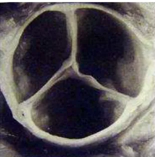 Figure 2 : valve aortique calcifiée 