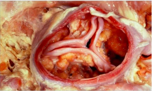 Figure 3 : valve aortique calcifiée 