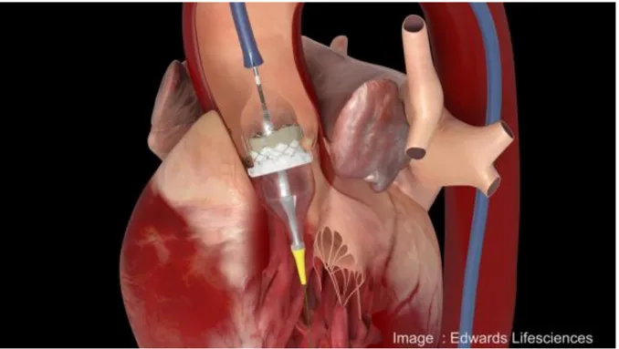 Figure 5 : implantation valve Edwards. 