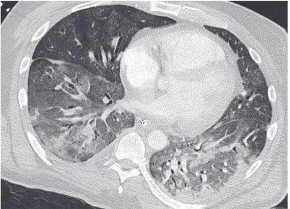 Figure 10 : coupe axiale d’angioscanner thoracique montrant une pneumopathie multi  lobaire chez un patient de 47 ans, sans comorbidité cardio-pulmonaire