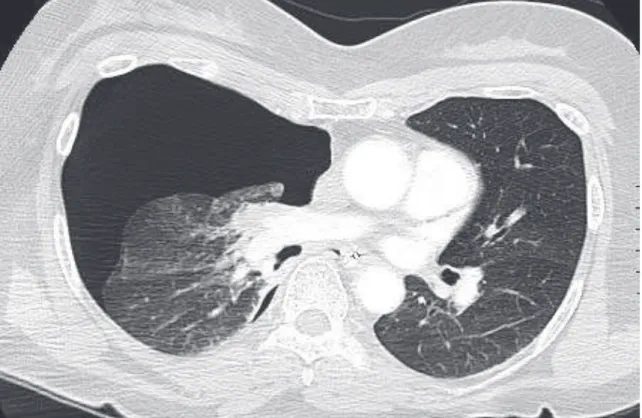Figure 16 : coupe axiale d’un angioscanner thoracique chez une patiente présentant une EP et  également un pneumothorax antérieur droit