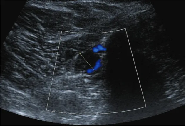 Figure 19 : écho doppler veineux des membres inférieurs d’une patiente de 50 ans présentant  une thrombose de la veine péronière droite