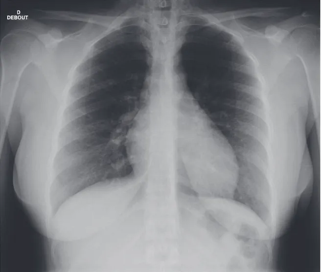 Figure 24 : radiographie pulmonaire de face d’une patiente qui présentait à l’angioscanner  thoracique une EP bilatérale : radiographie normale