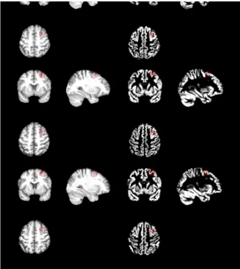 Figure  S1:  Anatomical  images  normalized  to  standard  space  (left)  and  the  resulting normalized  modulated  GM  segment  image  (right)  of  three  random  subjects  from  each cohorts with the rostral VOI highlighted in red.