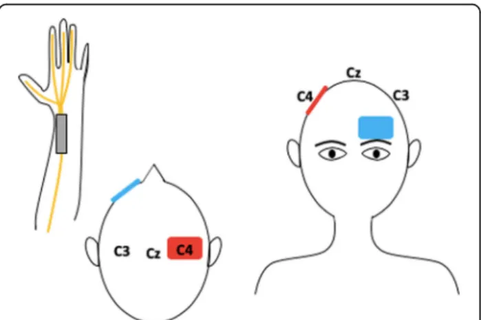 Fig. 2 Left median nerve stimulation combined with tDCS. Anodal stimulation of the right motor cortex (C4) with the reference electrode over the contralateral supraorbital region
