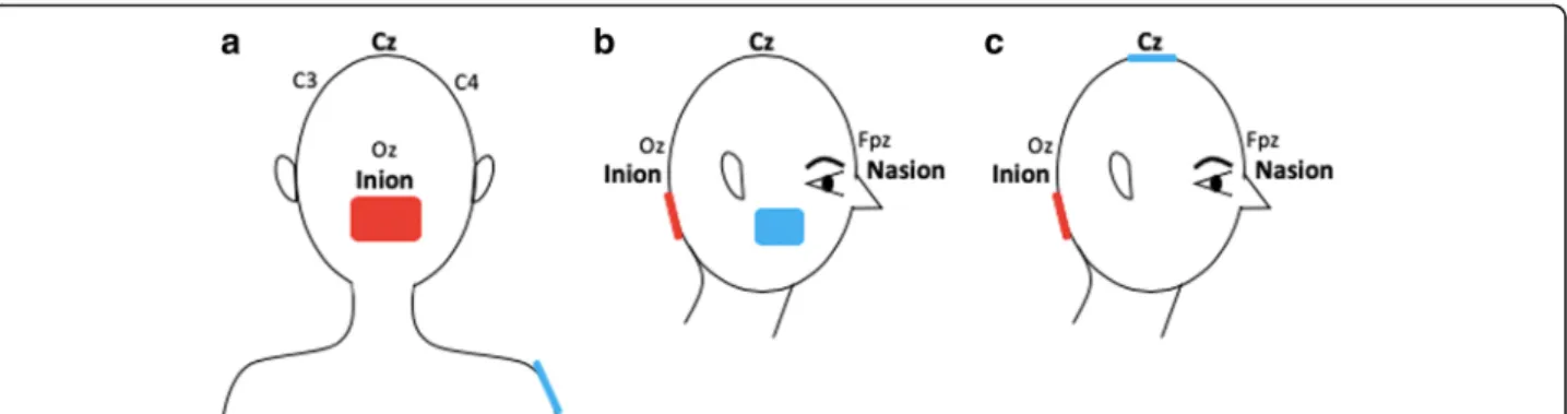 Fig. 4 Bilateral cerebellar hemispheres stimulation. The active electrode is placed 1 to 2 cm below the inion