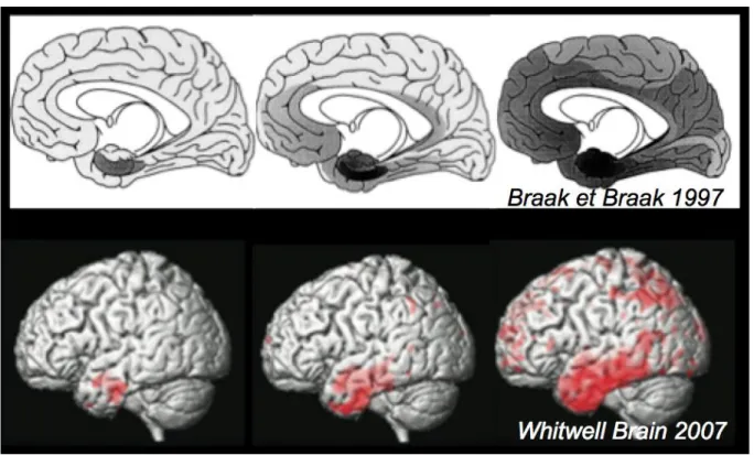 Figure 2 : Corrélation topographique entre DNF et atrophie cérébrale 