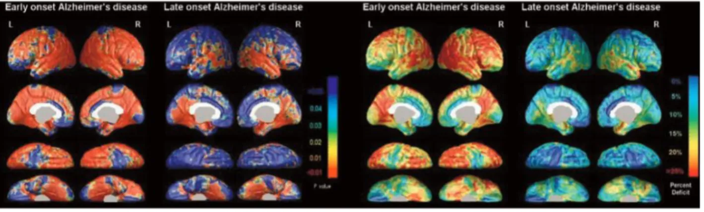 Figure 5 : Représentations graphique des zones d’atrophie apparaissant en rouge chez des  patients atteints de maladie d’Alzheimer (EOAD et LOAD) versus contrôle